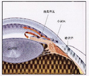 開(kāi)角型青光眼