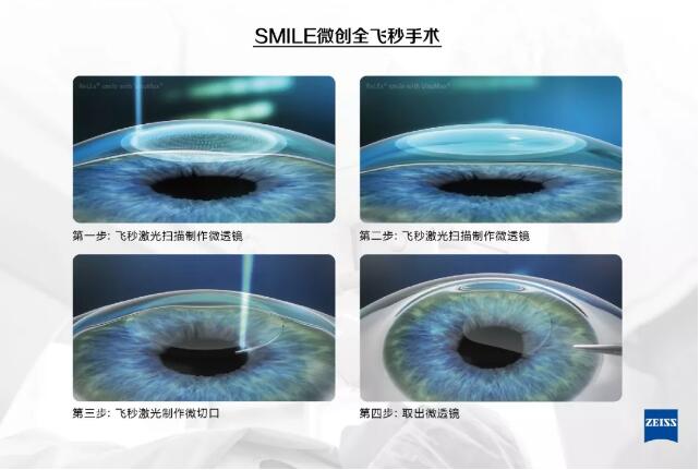 全飛秒激光近視眼手術
