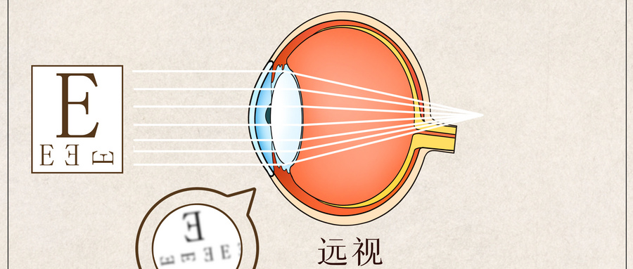 老花眼癥狀