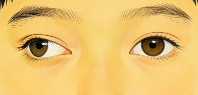 斜視